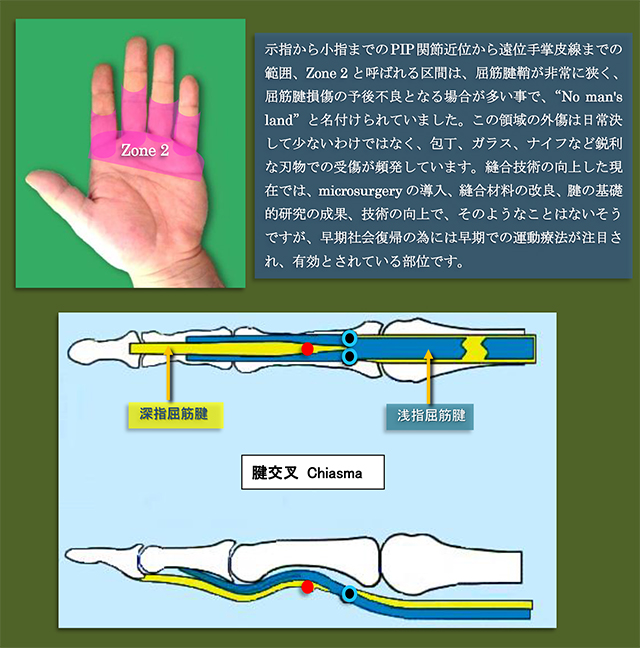 指 の リハビリ 腱